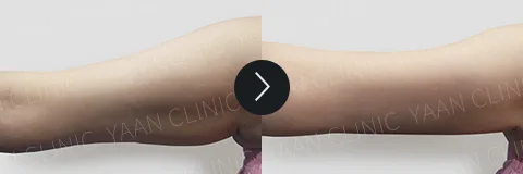 Before and after 3 months: Di-Fat fat reduction treatment - case 6