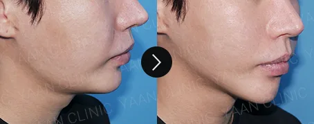 Before and after 1 month: Oligio lifting on the face - case 6