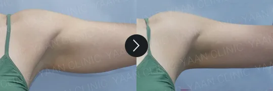 Before and after 3 months: Ulfit on the body - case 7