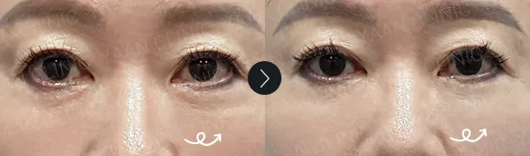 Before and after 2 months: under-eye and eyelid filler - case 10