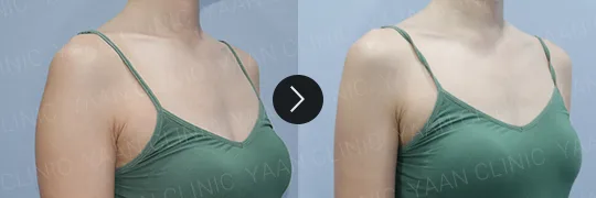 Before and after 3 months: Ulfit on the body - case 10