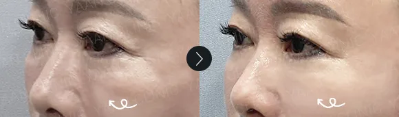 Before and after 2 months: under-eye and eyelid filler - case 14