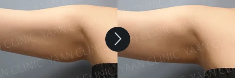 Before and after 3 months: Di-Fat fat reduction treatment - case 7