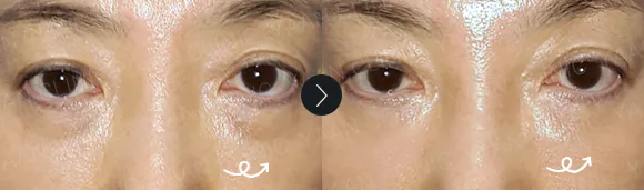 Before and after 2 months: under-eye and eyelid filler - case 11