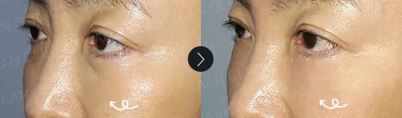 Before and after 2 months: under-eye and eyelid filler - case 15