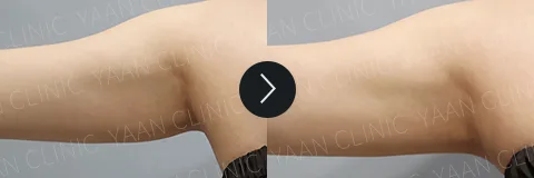 Before and after 3 months: Di-Fat fat reduction treatment - case 8