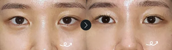 Before and after 2 months: under-eye and eyelid filler - case 12