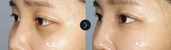 Before and after 2 months: under-eye and eyelid filler - case 16