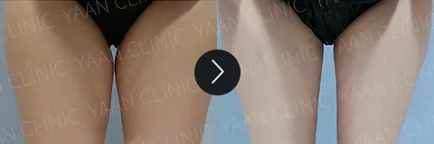 Before and after 3 months: Di-Fat fat reduction treatment - case 9