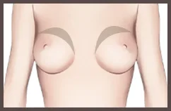 ภาพภายในคลินิก: เพิ่มวอลุ่มหน้าอกส่วนบน วอลุ่มเริ่มจากด้านบน