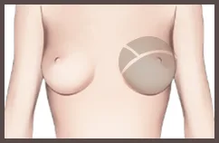 ภาพภายในคลินิกจากขั้นตอนฟิลเลอร์หน้าอก: แก้ไขความไม่สมมาตร ความสมดุลสร้างความมั่นใจ