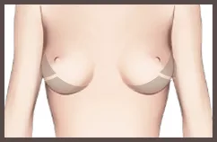 ภาพภายในคลินิก: เพิ่มวอลุ่มหน้าอกด้านข้าง อิ่มเต็มมีมิติ ไม่มีช่องว่าง