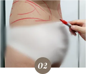 ภาพจากคลินิก: ขั้นตอนหัตถการสลายไขมัน (Di-Fat)