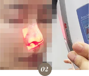 ภาพบรรยากาศคลินิกในขั้นตอนฟิลเลอร์: ขั้นตอนการฉีดฟิลเลอร์ที่ Yaan Clinic