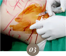 ภาพจากคลินิก: ขั้นตอนหัตถการสลายไขมัน (Di-Fat)