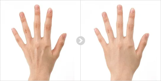 Type 3. — ソウル江南の Yaan Clinic の手の甲のしわフィラー