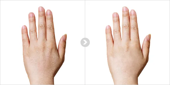Type 4. — ソウル江南の Yaan Clinic の手の甲のしわフィラー