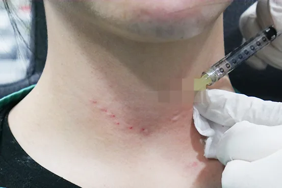 PDRN｜Neck Line Filler（Yaan Clinic 江南·首尔）