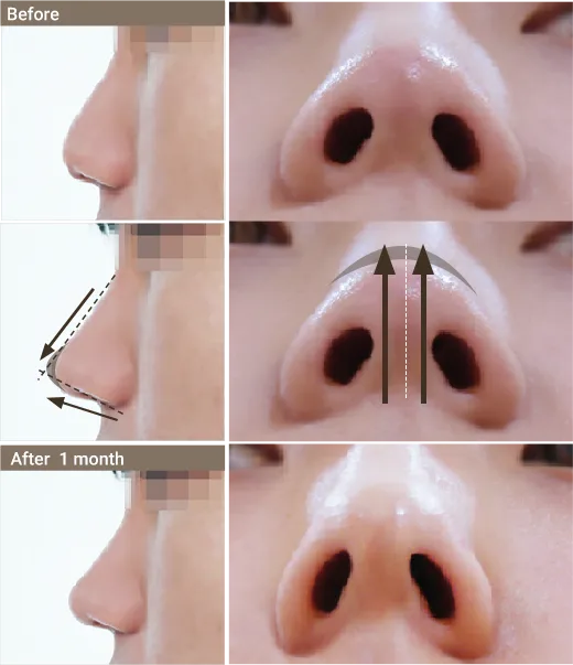 เสริมจมูกด้วยร้อยไหมและฟิลเลอร์ ออกแบบโดย Yaan Clinic