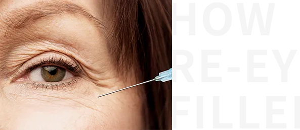 ส่วนประกอบของฟิลเลอร์ใต้ตาและเปลือกตา — Under-Eye and Eyelid Filler ที่ Yaan Clinic กังนัม โซล