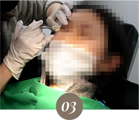 下眼睑与上眼睑填充流程的诊所实拍