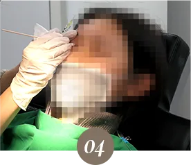 下眼睑与上眼睑填充流程的诊所实拍：高度重视面部整体协调