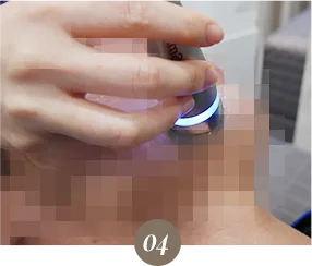 Yaan Clinic の Oligio リフト施術風景