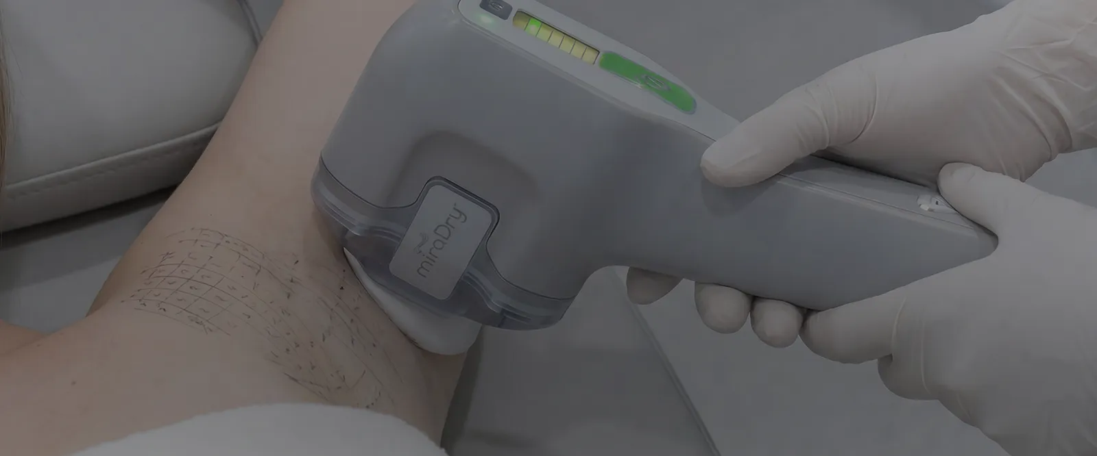miraDry fresh handpiece in use at YAAN Clinic