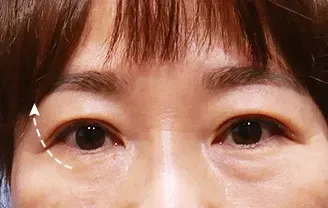 หลังทำ 3 เดือน: Eye Lifting บริเวณรอบดวงตา - เคส 1