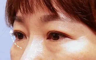 หลังทำ 3 เดือน: Eye Lifting บริเวณรอบดวงตา - เคส 2