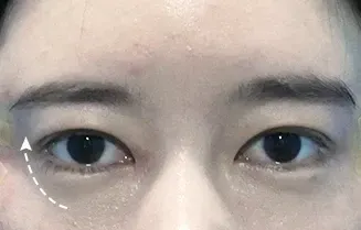 หลังทำ 3 เดือน: Eye Lifting บริเวณรอบดวงตา - เคส 3