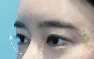 หลังทำ 3 เดือน: Eye Lifting บริเวณรอบดวงตา - เคส 4