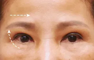 หลังทำ 3 เดือน: Eye Lifting บริเวณรอบดวงตา - เคส 5