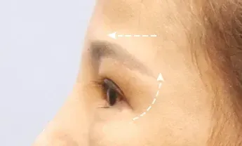 หลังทำ 3 เดือน: Eye Lifting บริเวณรอบดวงตา - เคส 6