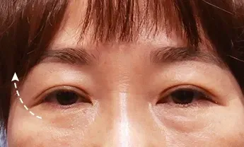 ก่อนทำ: Eye Lifting บริเวณรอบดวงตา - เคส 1
