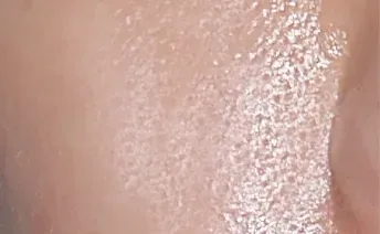 ก่อนทำ: Potenza Microneedling บนผิวหน้า - เคส 1