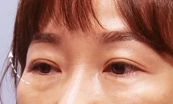 ก่อนทำ: Eye Lifting บริเวณรอบดวงตา - เคส 2
