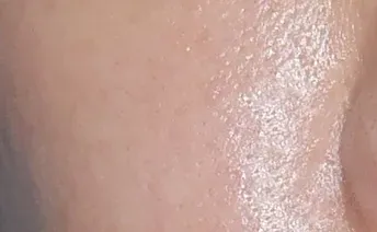 ก่อนทำ: Potenza Microneedling บนผิวหน้า - เคส 2