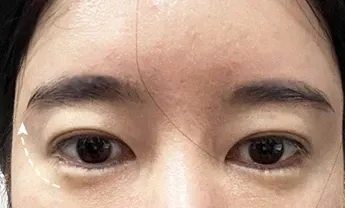 ก่อนทำ: Eye Lifting บริเวณรอบดวงตา - เคส 3