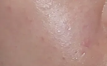 ก่อนทำ: Potenza Microneedling บนผิวหน้า - เคส 3