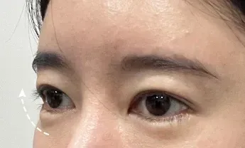 ก่อนทำ: Eye Lifting บริเวณรอบดวงตา - เคส 4