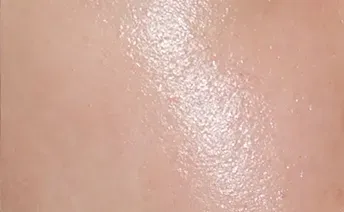 ก่อนทำ: Potenza Microneedling บนผิวหน้า - เคส 4