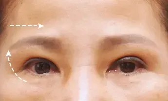 ก่อนทำ: Eye Lifting บริเวณรอบดวงตา - เคส 5