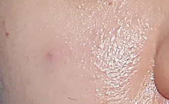 ก่อนทำ: Potenza Microneedling บนผิวหน้า - เคส 5