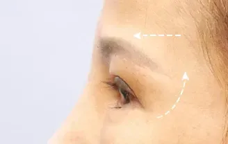 ก่อนทำ: Eye Lifting บริเวณรอบดวงตา - เคส 6