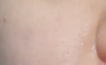 ก่อนทำ: Potenza Microneedling บนผิวหน้า - เคส 6