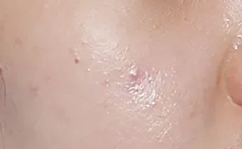 ก่อนทำ: Potenza Microneedling บนผิวหน้า - เคส 7