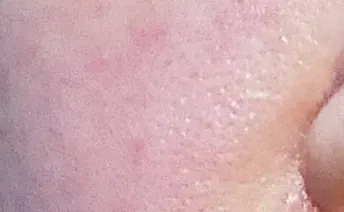 ก่อนทำ: Potenza Microneedling บนผิวหน้า - เคส 9