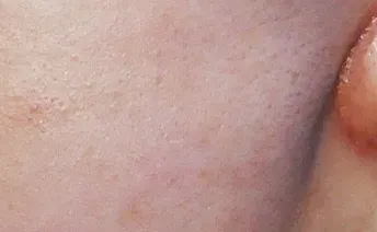 ก่อนทำ: Potenza Microneedling บนผิวหน้า - เคส 11