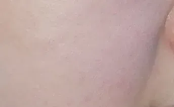 ก่อนทำ: Potenza Microneedling บนผิวหน้า - เคส 12